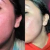Before and after results using The Ordinary Glycolic Acid 7% Toning Solution for smoother, clearer, and brighter skin