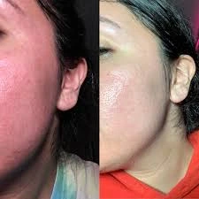 Before and after results using The Ordinary Glycolic Acid 7% Toning Solution for smoother, clearer, and brighter skin